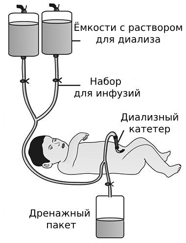 Перитонеальный диализ Перитонеальный диализ