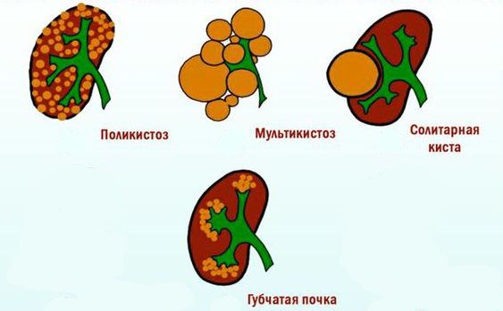 Виды кистозных аномалий почки Виды кистозных аномалий почки