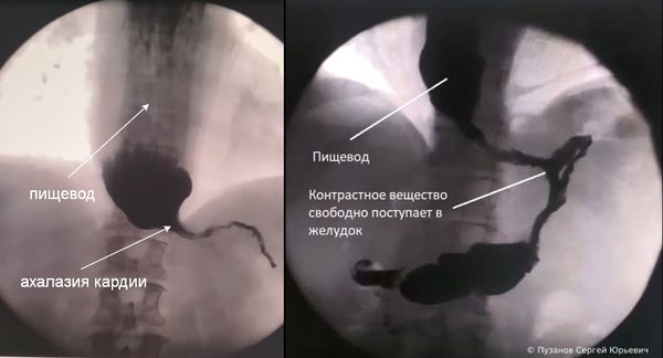 Рентгенограмма с контрастированием до и после операции