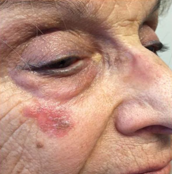 Актинический кератоз [20]