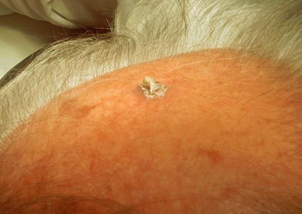 Кожный рог [24]