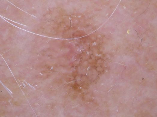 Пигментированная форма актинического кератоза [21]