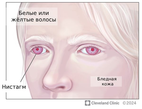 Альбинизм [34]