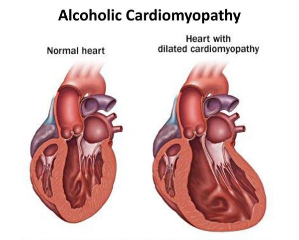 Алкогольная кардиомиопатия