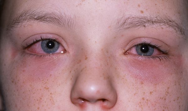 Симптомы аллергического конъюнктивита [11]