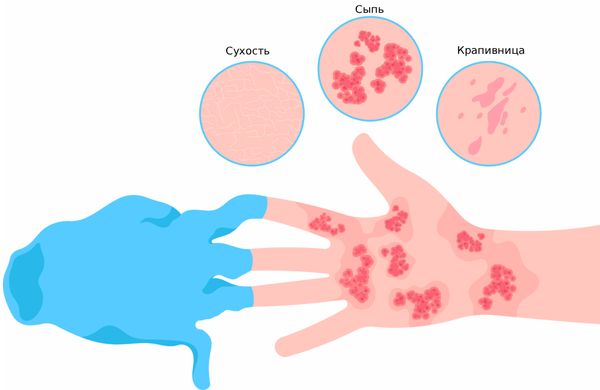 Аллергия на латекс