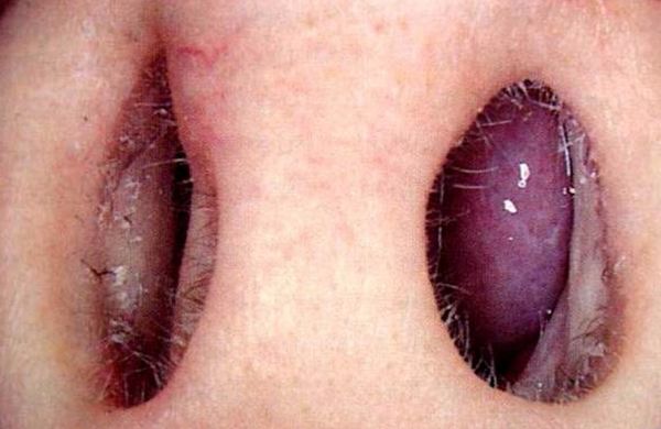 Бледно-синюшные носовые раковины [23]