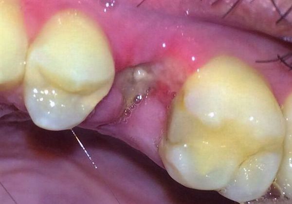 Воспаление лунки (альвеолы) зуба