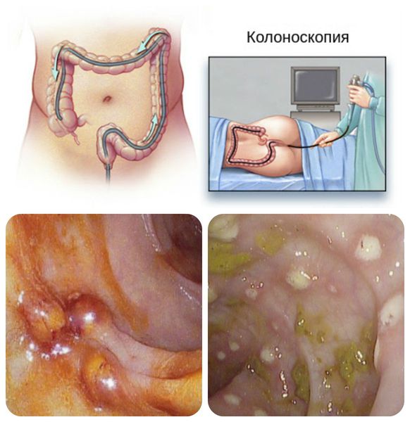 Колоноскопия: визуализация абсцессов и язв кишечника