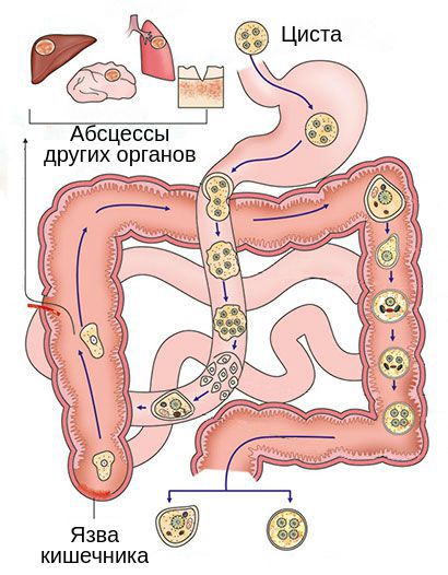 Механизм развития кишечного амёбиаза