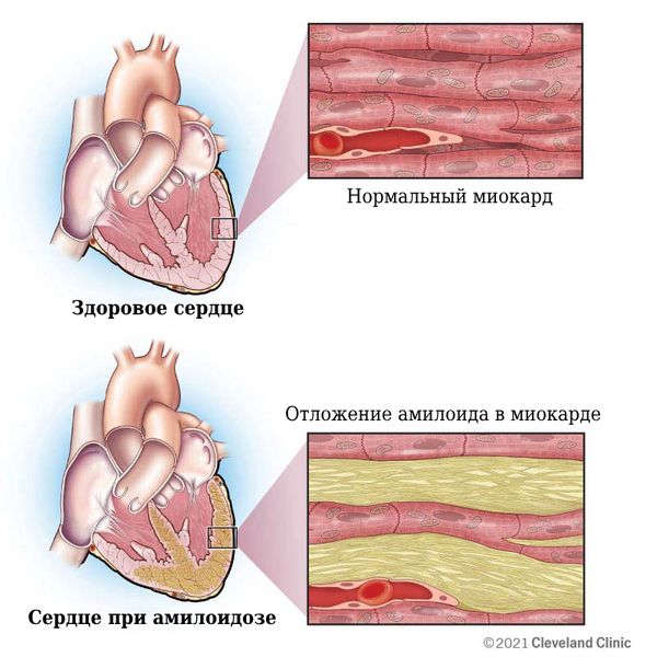 Отложение амилоида в сердце