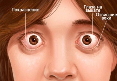 Эндокринная офтальмопатия