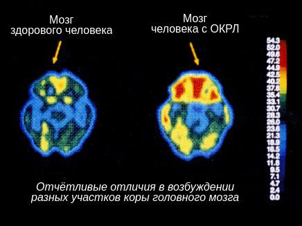 Отличие работы здорового мозга от мозга человека с ананкастным расстройством