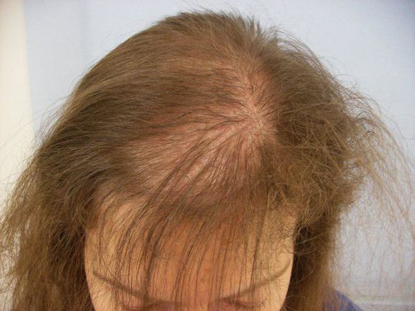 alopeciya u zhenshin s