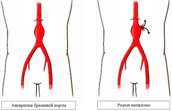 Разрыв аневризмы брюшной аорты