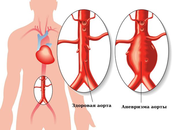 Здоровая аорта и аневризма аорты