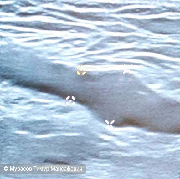 Аневризма артерии при УЗДС