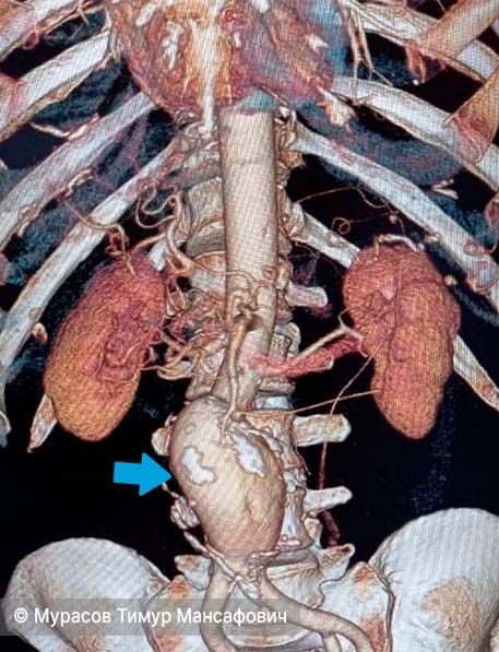 Аневризма брюшной аорты при КТ. 3D реконструкция