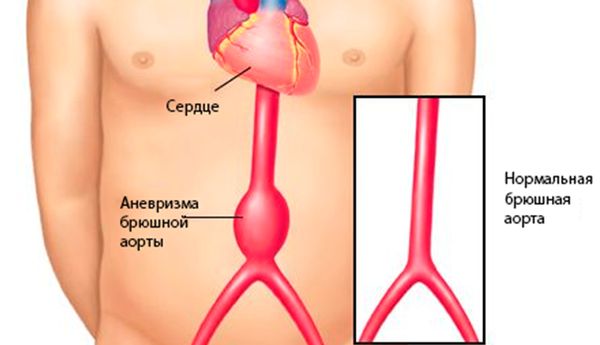 Аневризма и расслоение аорты