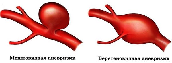 Мешковидная и веретеновидная аневризмы