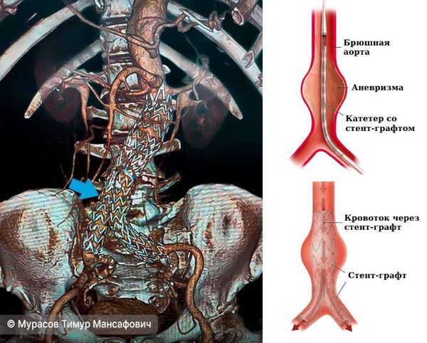 Установленный стент-графт