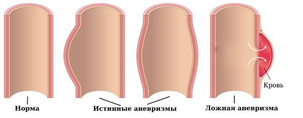 Истинные и ложная аневризмы
