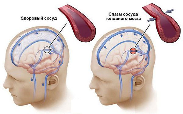 Лечение ангиоспазмов головного мозга