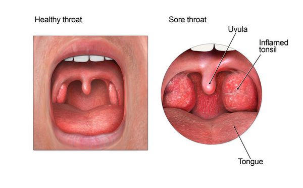 Здоровое и воспалённое горло