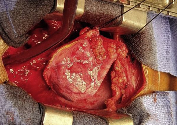 Ангиосаркома сердца [17]