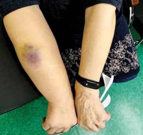 Лимфангиосаркома на руке (синдром Стюарта — Тревеса) [7]