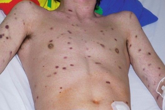 Саркома Капоши [16]