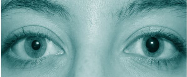 Анизокория [8]