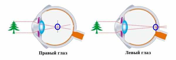 Разная рефракция правого и левого глаза