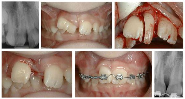 Комплексное лечение слияния зубов