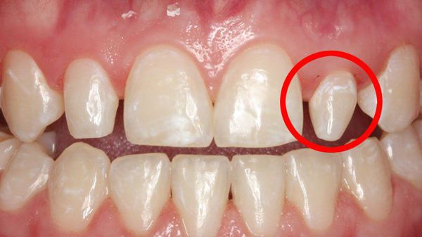 Малая аномалия развития зубов