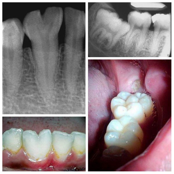 Раздвоенный (слева) и сросшиеся зубы (справа): внешний вид и рентгенограмма