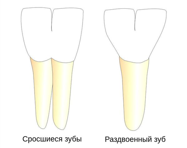 Сросшиеся и раздвоенные зубы