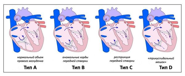 Анатомическая классификация аномалии Эбштейна [15]