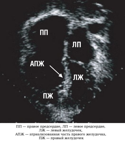 Апикальное смещение створок трикуспидального клапана на ЭхоКГ [18]