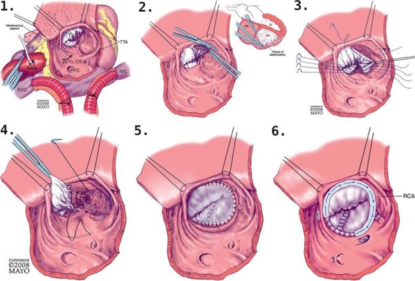 Этапы конусной реконструкции ТК при аномалии Эбштейна [17]
