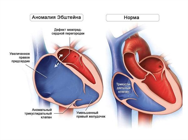Сердце при аномалии Эбштейна и в норме