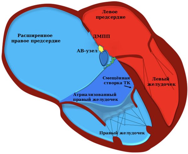 Схематичное строение сердца при АЭ [14]