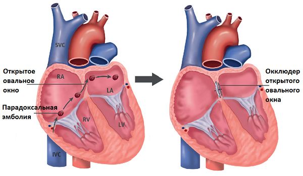 Закрытие открытого овального окна при помощи окклюдера
