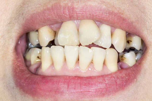 Аномалии зубов и кариес