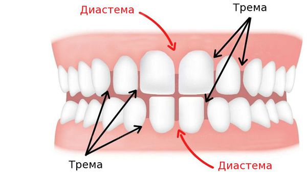 Промежутки между зубами: диастема и трема