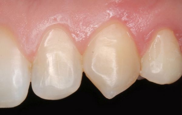 Зуб шиповидной формы