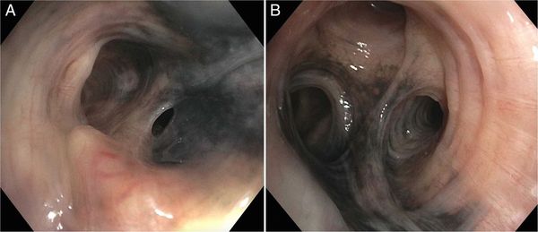 Чёрный оттенок бронхов при фибробронхоскопии [13]
