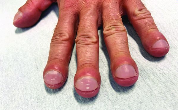 Пальцы Гиппократа [12]