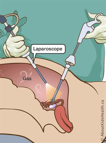 Лапароскопия