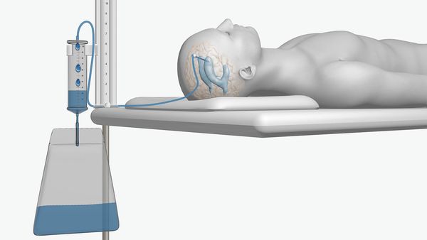 Ликворошунтирующая операция